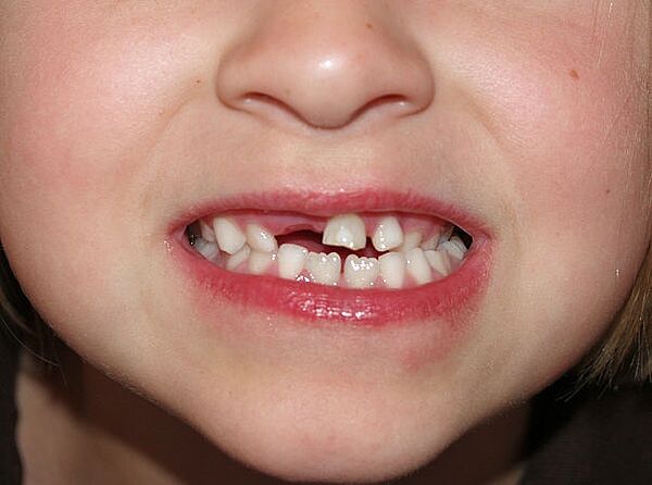 Zahnlücke bei Kind