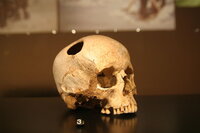 Trepanation